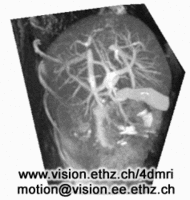 4D MRI of the liver