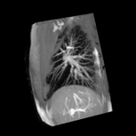 4DMRI of the lung